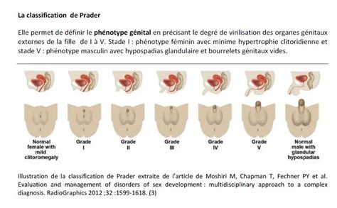 Hypertrophie clitoridienne : symptômes, traitement,。